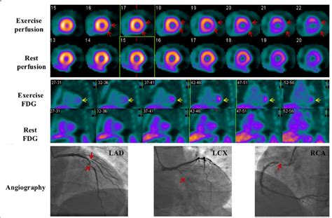 Images of a 39-year-old man. He had a 70% stenosis in the LAD and a 90% ...