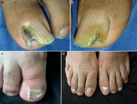 Proximal Subungual Onychomycosis