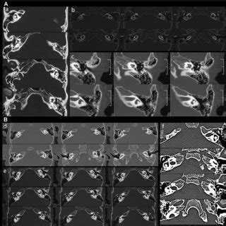 Temporal bone CT scans of WS probands. a Normal temporal bone CT scan ...