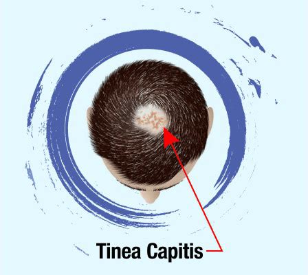 Tinea Capitis - Symptoms, Causes, Treatment & Prevention | RichFeel