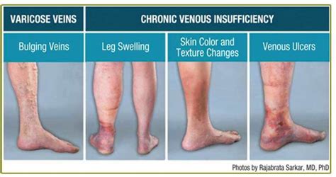 Is Your Leg Pain Venous Insufficiency? | CVR Blog | USA