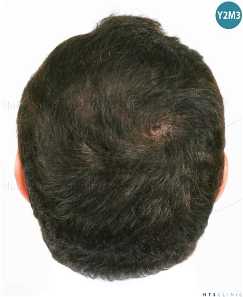 A very nice vertex work again | Hair loss Forum - Hair Transplant forums