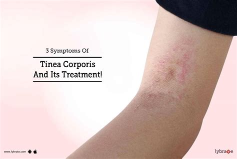 Tinea Corporis Causes