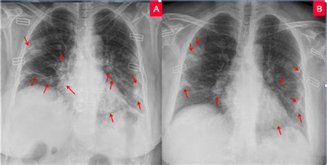 The Role of Chest X-Ray in Monitoring Lung Changes among COVID-19 Patients in Gaza Strip