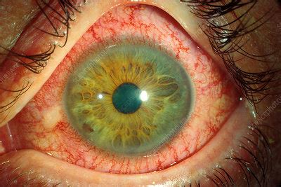 Acute anterior uveitis - Stock Image - C034/5826 - Science Photo Library