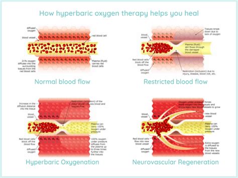 How does Hyperbaric Oxygen Therapy heal wounds? | Hyperbaric Healing ...