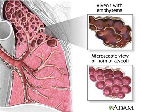 Artificial lungs: picture of damaged alveoli