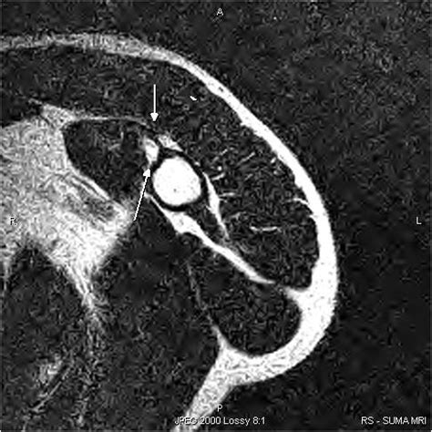 Long head of Biceps Rupture-MRI - Sumer's Radiology Blog