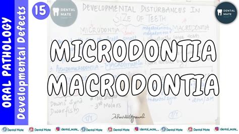 Microdontia | Macrodontia | Developmental disturbances in size of teeth ...