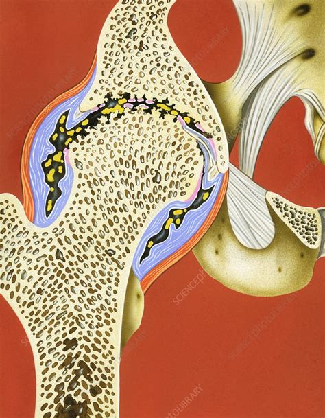 Hip joint cartilage loss, illustration - Stock Image - C029/0665 - Science Photo Library