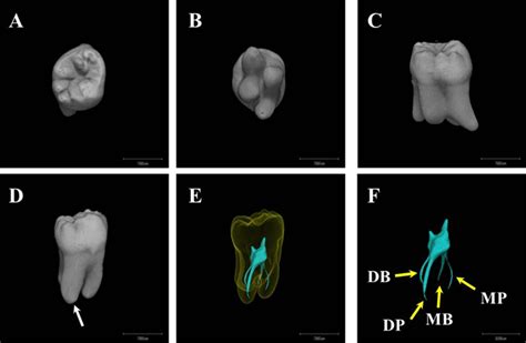 FULL TEXT -Unusual root canal anatomy in a maxillary second molar - International Journal of ...