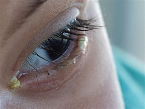 Dry Eye Discharge: What's Typical