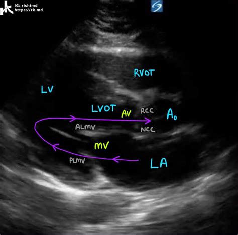 Normal Echocardiogram