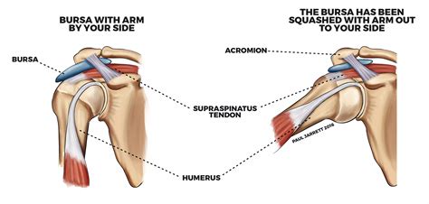 Shoulder Impingement Syndrome Bursitis Or Tendonitis Orthopedists | The ...