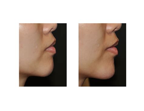 Case Study: Juvederm Voluma Injections for Chin Augmentation - Explore ...