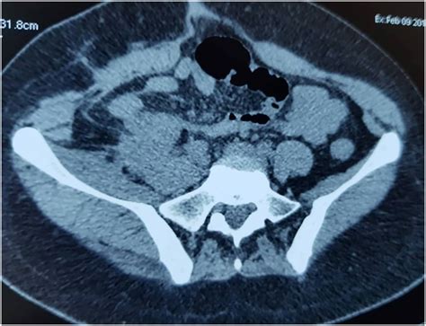 CT Scan 2 months postoperatively: stability of the tumoral residue on... | Download Scientific ...