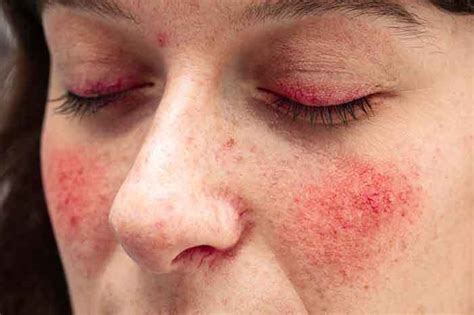 Does Rosacea Cause Dry Skin? – What to look out for!