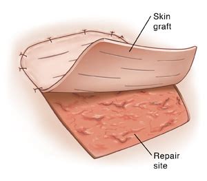 Skin Graft Surgery