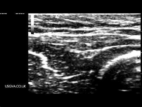 Radial Nerve: Ultrasound Radial Nerve Block At Elbow