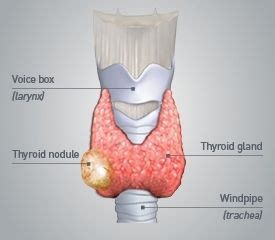 Thyroid nodules symptoms and causes – Artofit