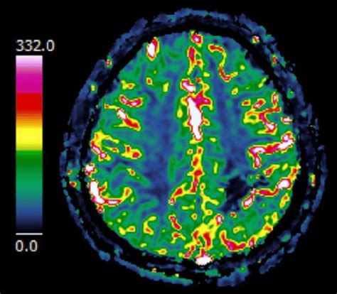 Brain perfusion magnetic resonance imaging (MRI) showed increased... | Download Scientific Diagram