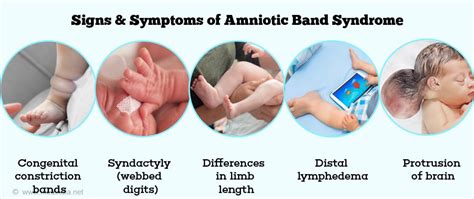 Amniotic Band Syndrome - Causes, Risk Factors, Symptoms, Diagnosis & Treatment