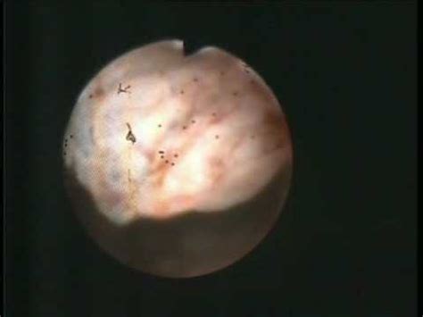 Endometrial atypical hyperplasia. Office flexible hysteroscopy. - YouTube