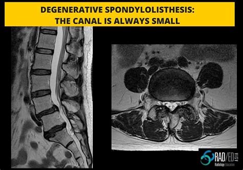 SPONDYLOLISTHESIS: PARS DEFECT OR DEGENERATION: HOW TO DIFFERENTIATE QUICKLY - Radedasia