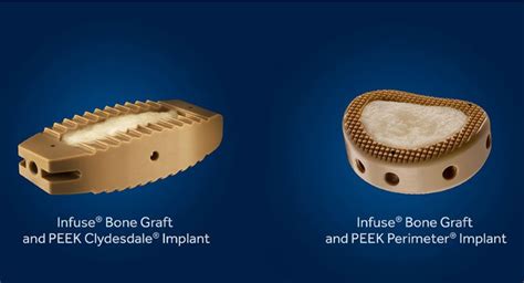 FDA Approves Infuse Bone Graft For Three New Spine Surgery Indications | Orthopedic Design ...