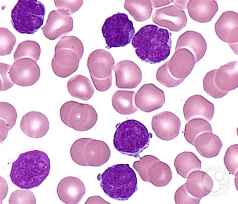 T-cell Prolymphocytic Leukemia - 6.