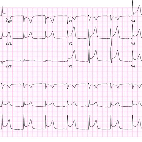 ECG pericarditis. ECG abnormalities suggestive of pericarditis in a 40 ...