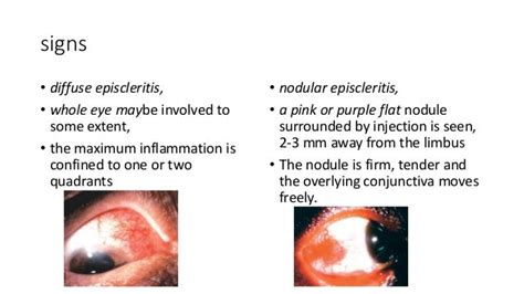 Diseases of sclera ppt ophthalmology