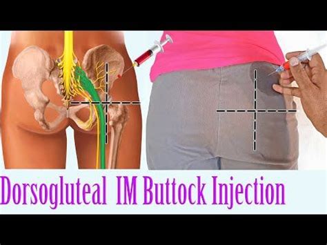 How to give an IM Intramuscular injection in the Buttocks | Hip Dorsogluteal Injection Technique