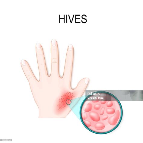 Hives On Hands