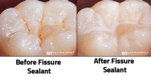 What are Fissure Sealants? - Dental at Keys