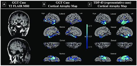 Imaging findings in GGT case and comparison to TDP. A. Patient's T2... | Download Scientific Diagram