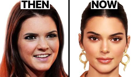 What Happened to Kendall Jenner's Face? | Plastic Surgery Analysis - Cyber Clinic