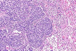 Atypical lung carcinoid tumour - Libre Pathology