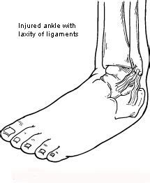 Joint Pain and Ankle Instability