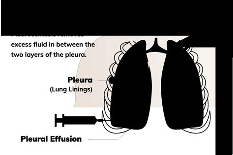 Mesothelioma Pleurocentesis | Benefits, Risks & More