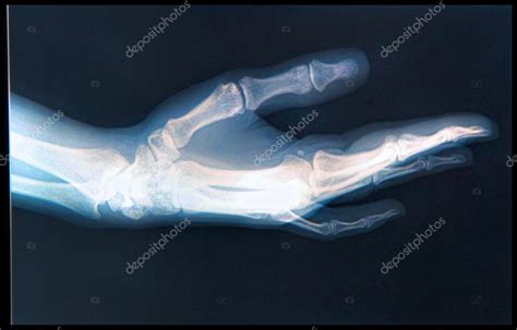 X-ray of human Hand — Stock Photo © Bunyos30 #25933399