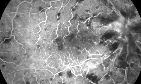 Central Retinal Vein Occlusion