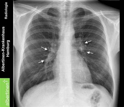 X-ray of the thorax: Sarcoidosis I , lateral - DocCheck