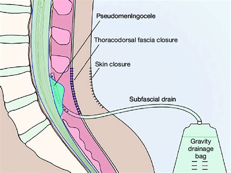 Spinal Drainage Procedure - Best Drain Photos Primagem.Org