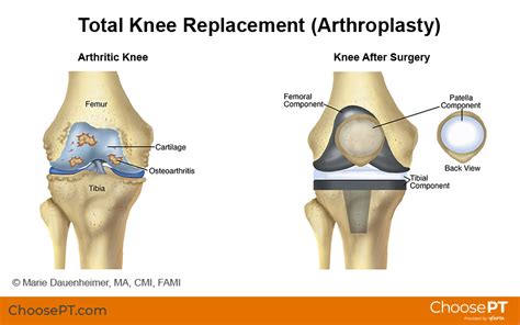 Osteoarthritis Knee Replacement