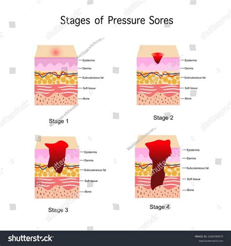 53 Stages Pressure Sore Images, Stock Photos & Vectors | Shutterstock