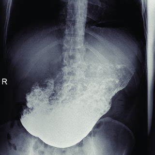 X-ray examination: barium sulphate was used as contrast agent. Repeated... | Download Scientific ...