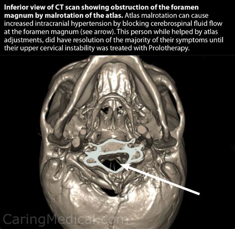 Cerebellar tonsillar ectopia herniation and Chiari 1 malformation: Non ...