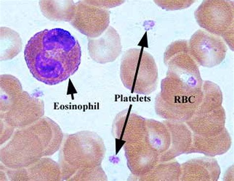 Could you have a Eosinophils allergy?