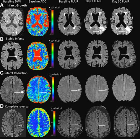 Dynamic Evolution of Diffusion-Weighted Imaging Lesions in Patients ...